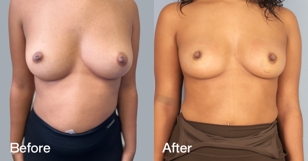 Inverted nipple correction is a surgical procedure for men and women who donโt feel comfortable with their inverted nipples. An inverted nipple is a nipple that appears flat or turns inward, whereas regular nipples project forward. Before And After Inverted Nipple Surgery, Front View - Patient 1