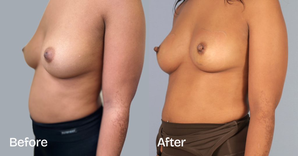 Inverted nipple correction is a surgical procedure for men and women who donโt feel comfortable with their inverted nipples. An inverted nipple is a nipple that appears flat or turns inward, whereas regular nipples project forward. Before And After Inverted Nipple Surgery, Left Front View - Patient 1