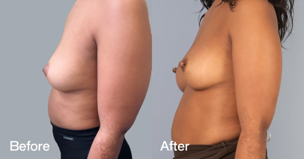 Inverted nipple correction is a surgical procedure for men and women who donโt feel comfortable with their inverted nipples. An inverted nipple is a nipple that appears flat or turns inward, whereas regular nipples project forward. Before And After Inverted Nipple Surgery, Left View - Patient 1
