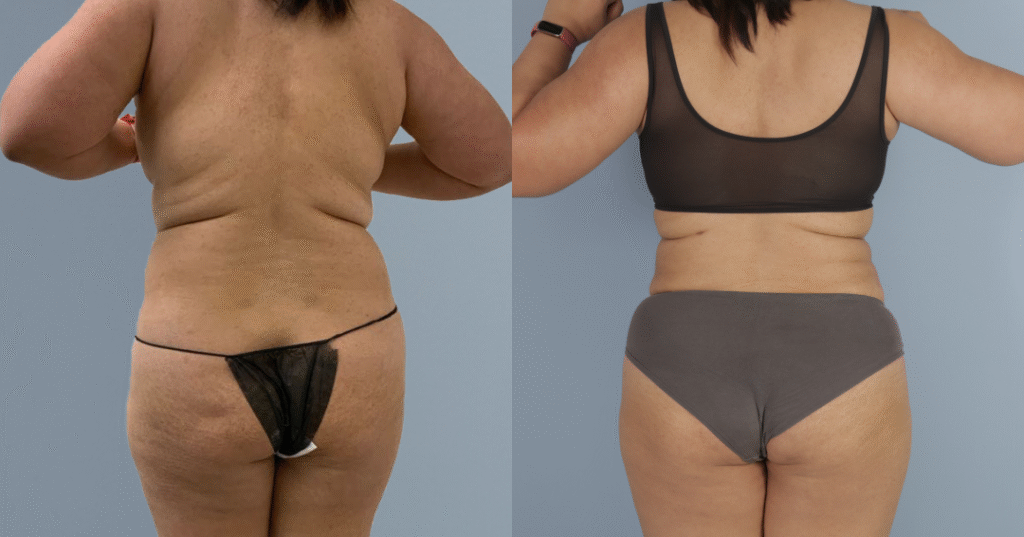 A Patient Before And After Liposuction