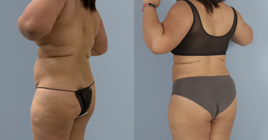A Patient Before And After Liposuction
