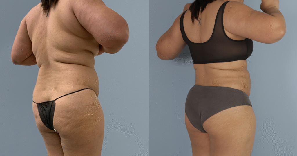 A Patient Before And After Liposuction