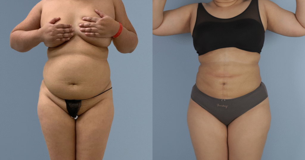 A Patient Before And After Liposuction