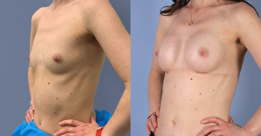 A Patient Before And After Breast Augmentation