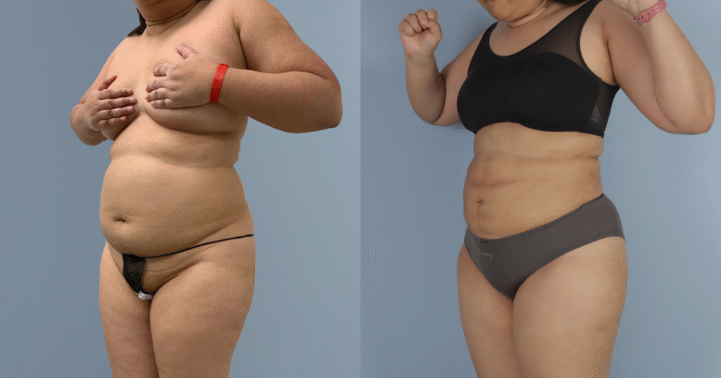 A Patient Before And After Liposuction