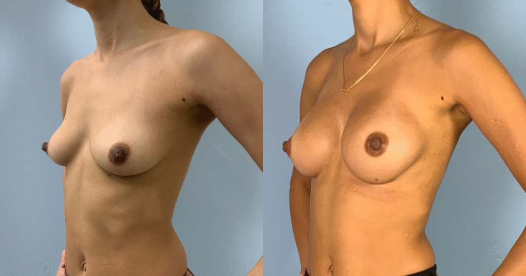 A Patient Before And After Breast Augmentation