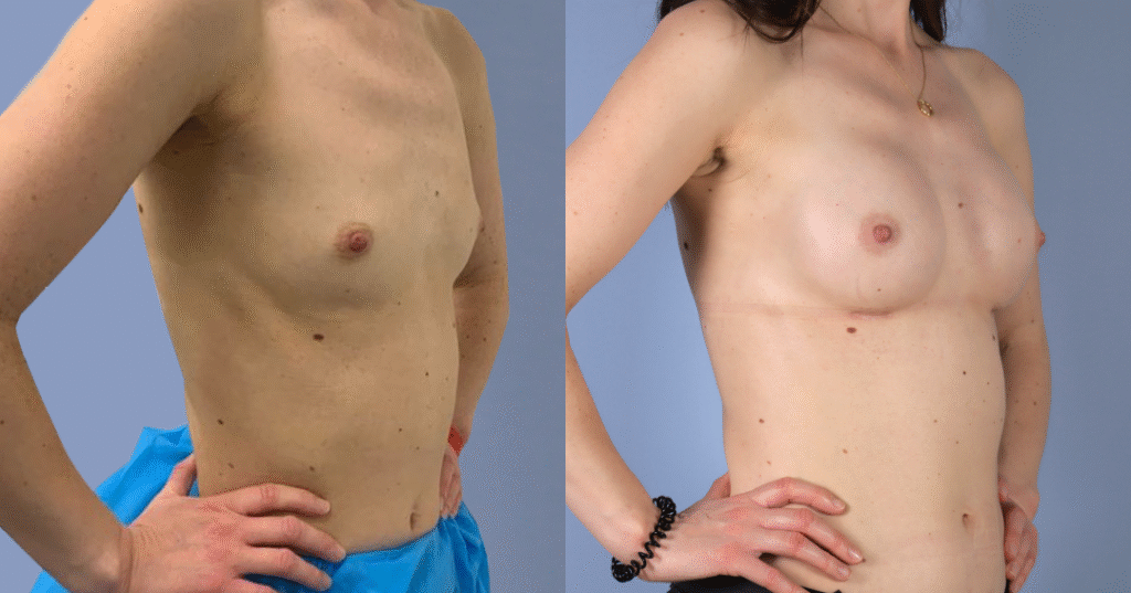A Patient Before And After Breast Augmentation