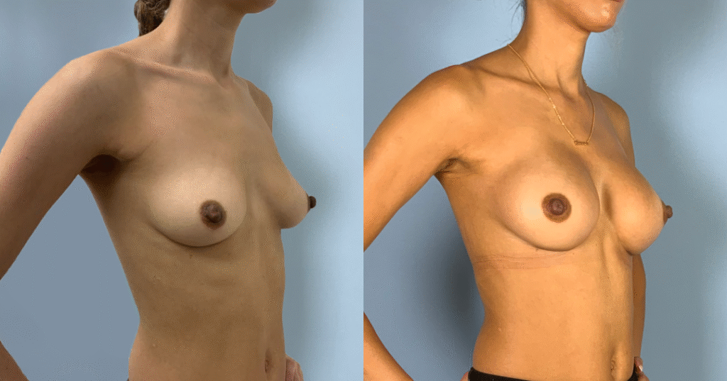 A Patient Before And After Breast Augmentation