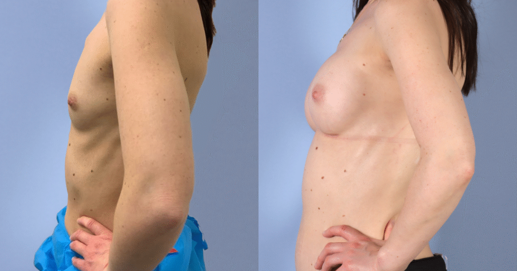 A Patient Before And After Breast Augmentation