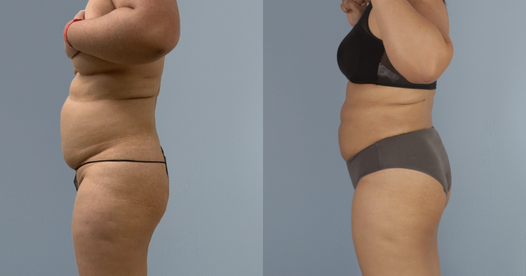 A Patient Before And After Liposuction