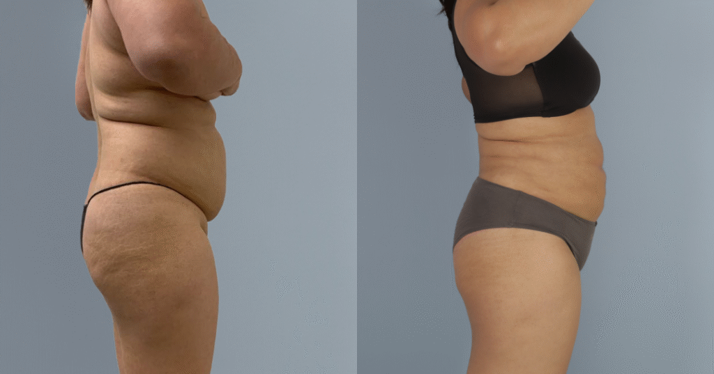 A Patient Before And After Liposuction