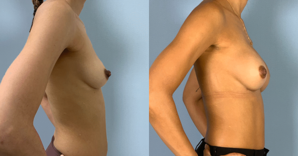 A Patient Before And After Breast Augmentation