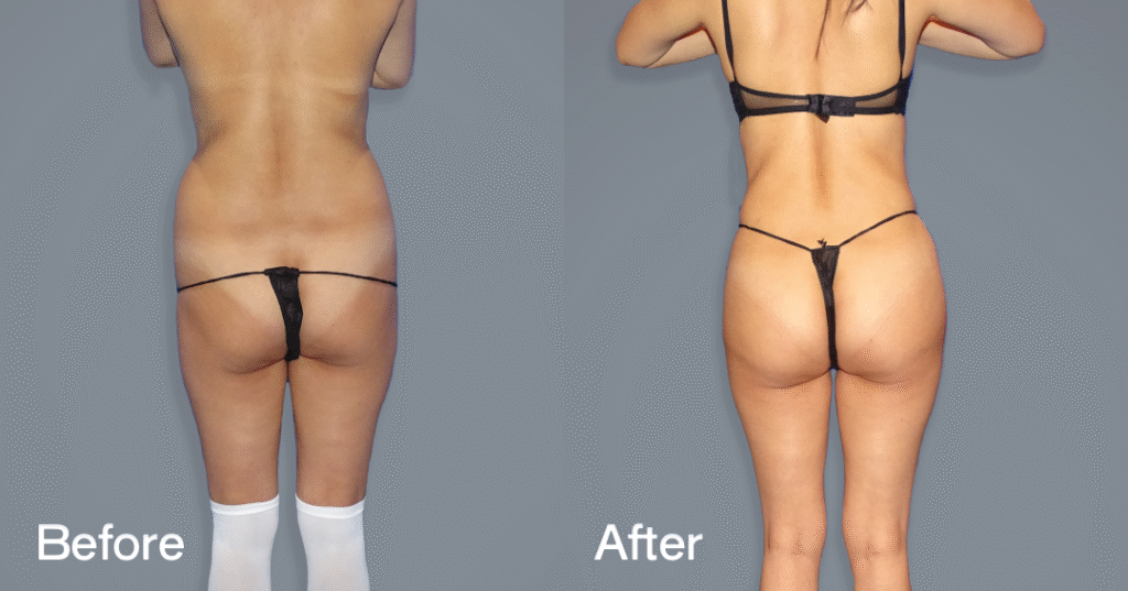 Do you want a bigger butt? Learn about the best big butt surgery from CREO Clinic in London. Before And After Bbl, Back View - Patient 1