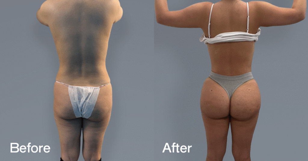 Do you want a bigger butt? Learn about the best big butt surgery from CREO Clinic in London. Before And After Bbl, Back View - Patient 8