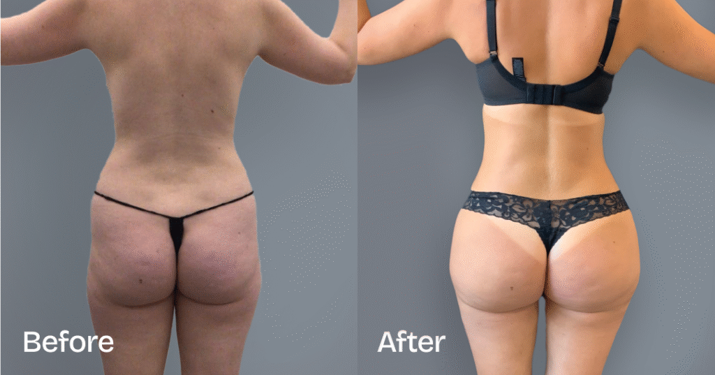 Do you want a bigger butt? Learn about the best big butt surgery from CREO Clinic in London. Big Butt Surgery