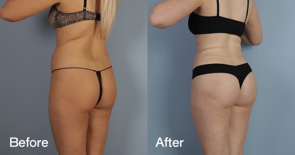 Do you want a bigger butt? Learn about the best big butt surgery from CREO Clinic in London. Before And After Bbl, Back Left View - Patient 4