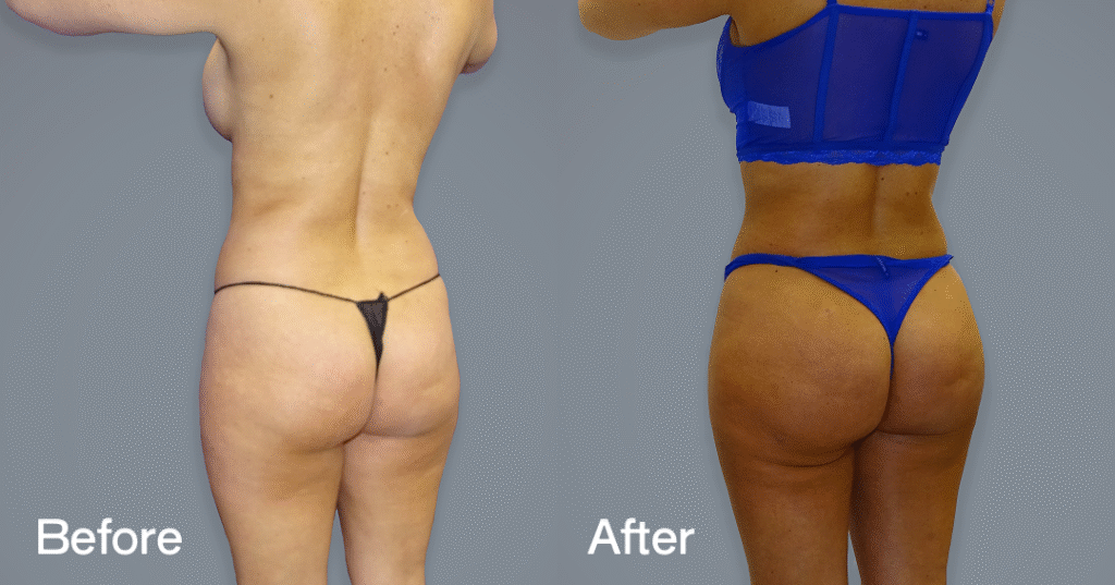 Do you want a bigger butt? Learn about the best big butt surgery from CREO Clinic in London. Before And After Bbl, Back View - Patient 3