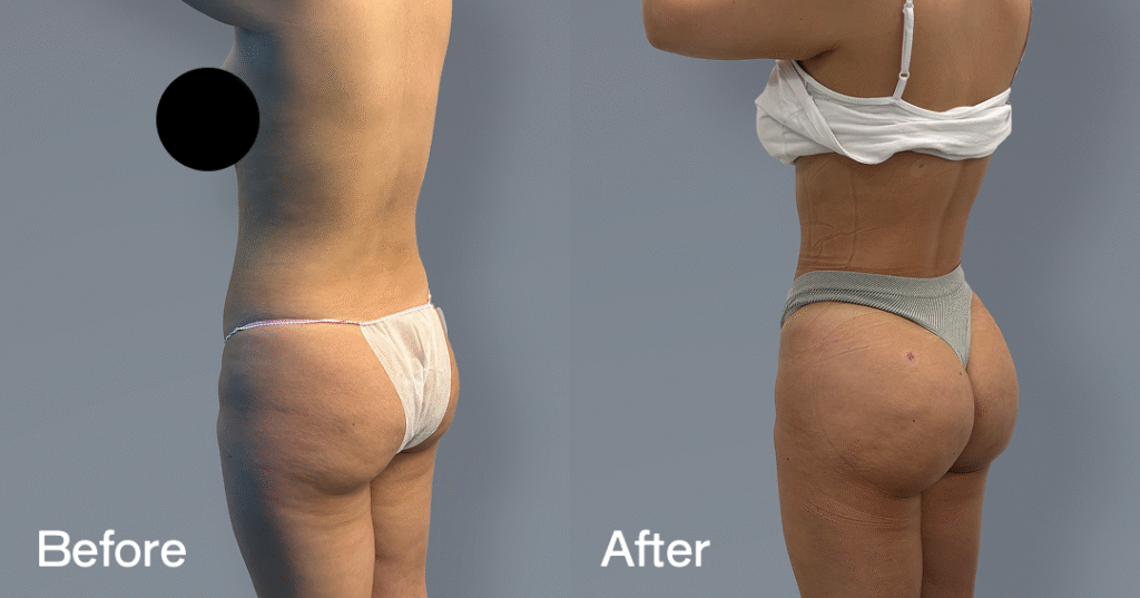 Do you want a bigger butt? Learn about the best big butt surgery from CREO Clinic in London. Before And After Bbl, Back Left View - Patient 8