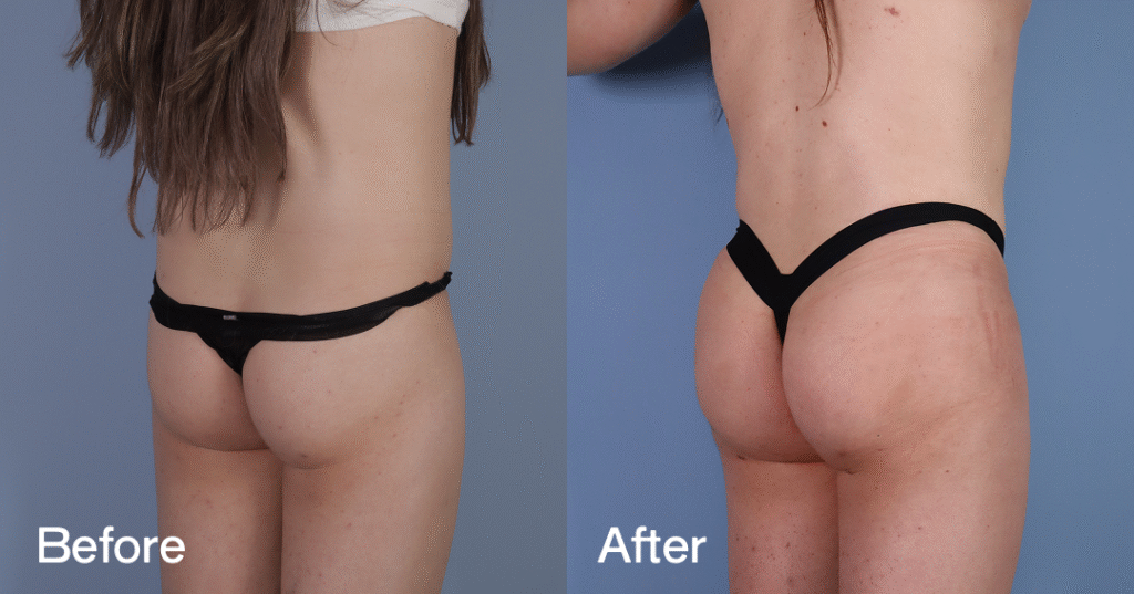 Do you want a bigger butt? Learn about the best big butt surgery from CREO Clinic in London. Before And After Bbl, Back Right View - Patient 5