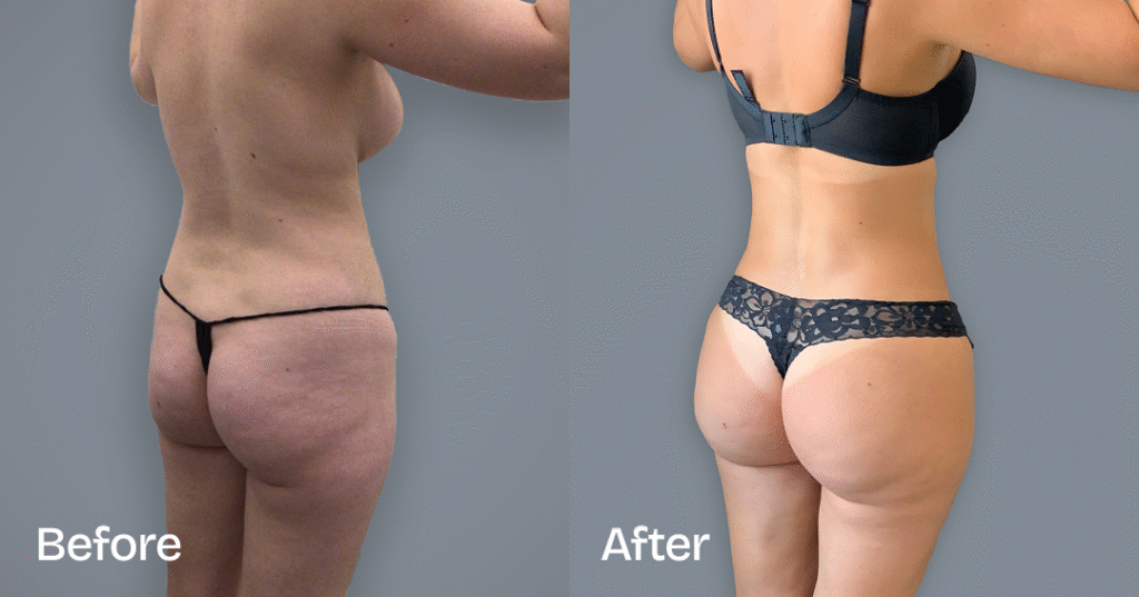 Do you want a bigger butt? Learn about the best big butt surgery from CREO Clinic in London. Before And After Bbl, Back Right View - Patient 7