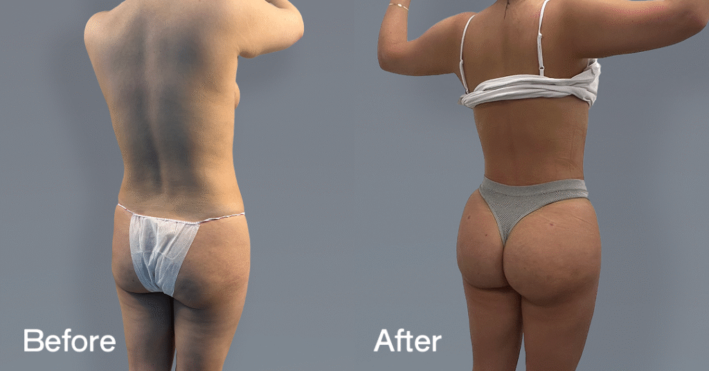 Do you want a bigger butt? Learn about the best big butt surgery from CREO Clinic in London. Before And After Bbl, Back Right View - Patient 8