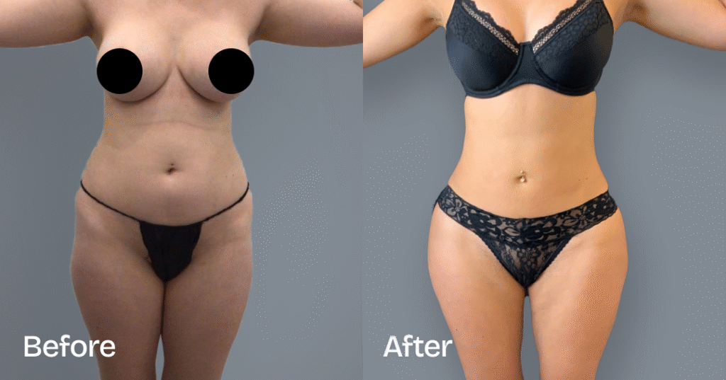 Do you want a bigger butt? Learn about the best big butt surgery from CREO Clinic in London. Before And After Bbl, Front View - Patient 7