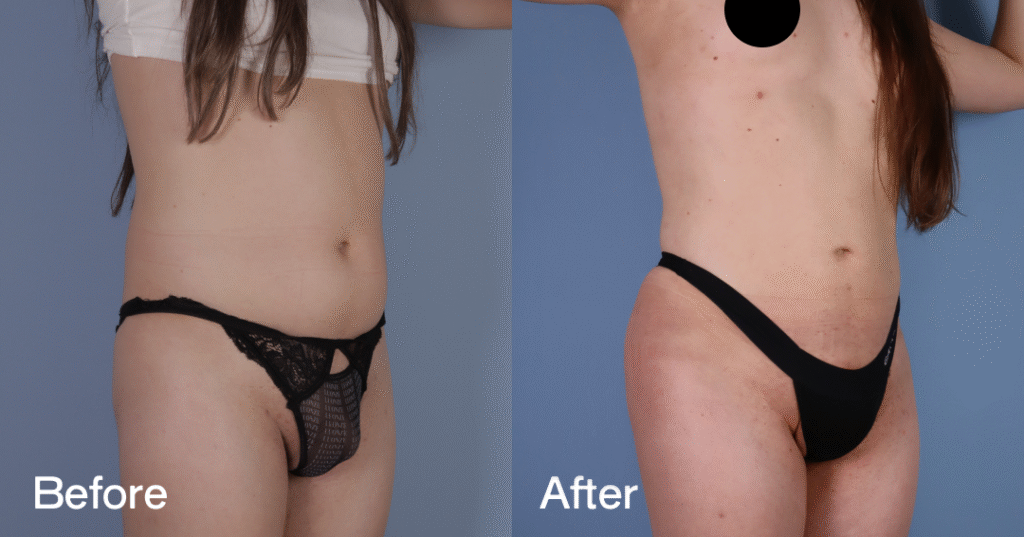 Do you want a bigger butt? Learn about the best big butt surgery from CREO Clinic in London. Big Butt Surgery