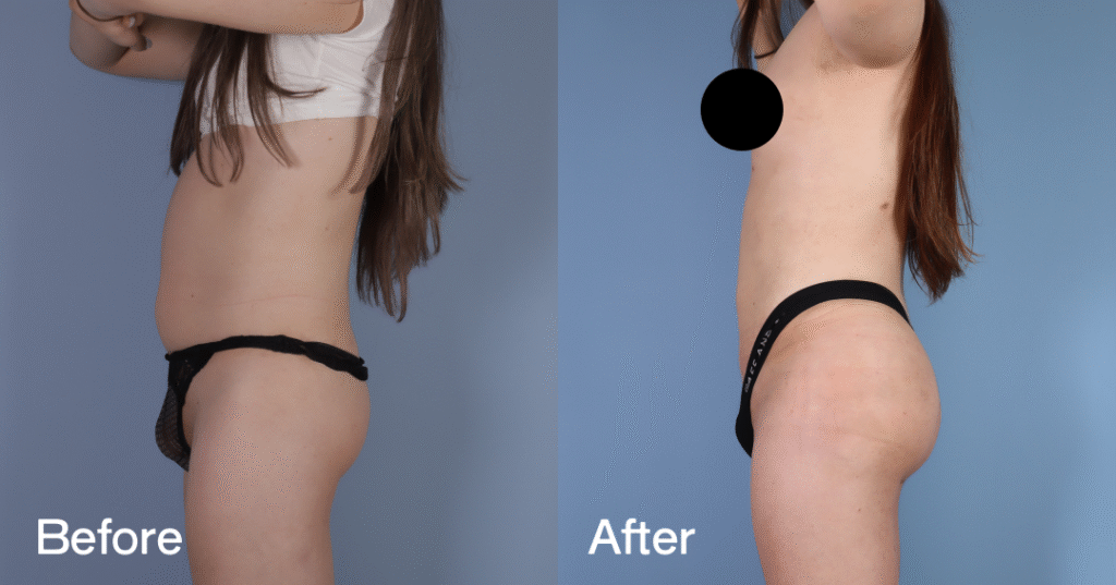 Do you want a bigger butt? Learn about the best big butt surgery from CREO Clinic in London. Before And After Bbl, Left View - Patient 5