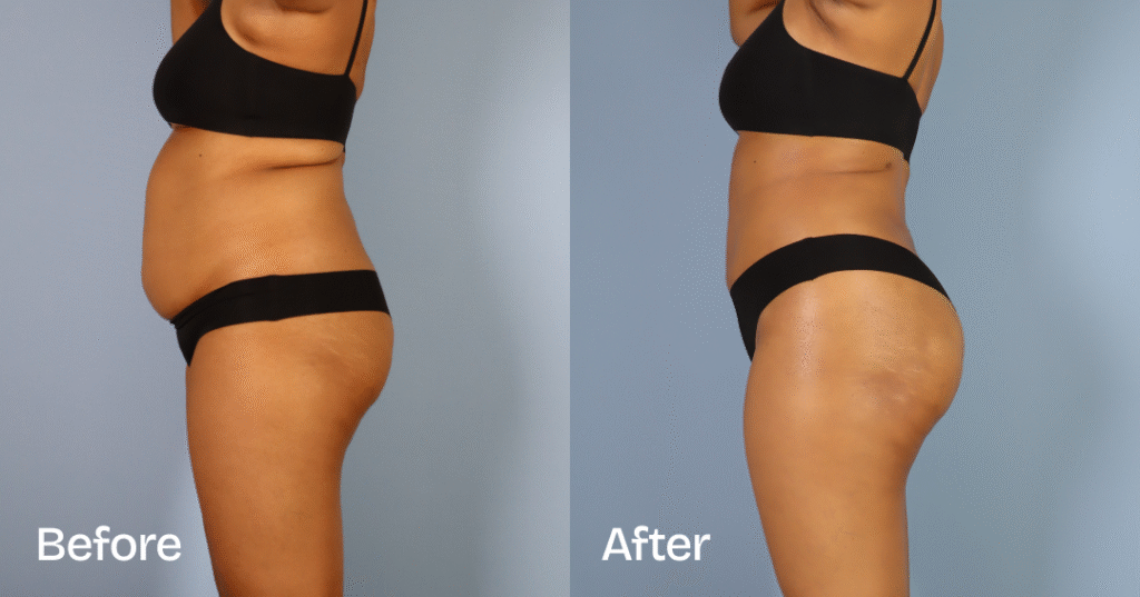 Do you want a bigger butt? Learn about the best big butt surgery from CREO Clinic in London. Before And After Bbl, Left View - Patient 6