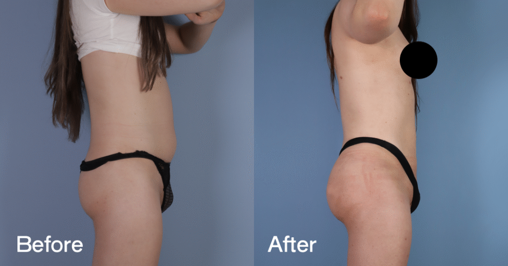 Do you want a bigger butt? Learn about the best big butt surgery from CREO Clinic in London. Before And After Bbl, Right View - Patient 5