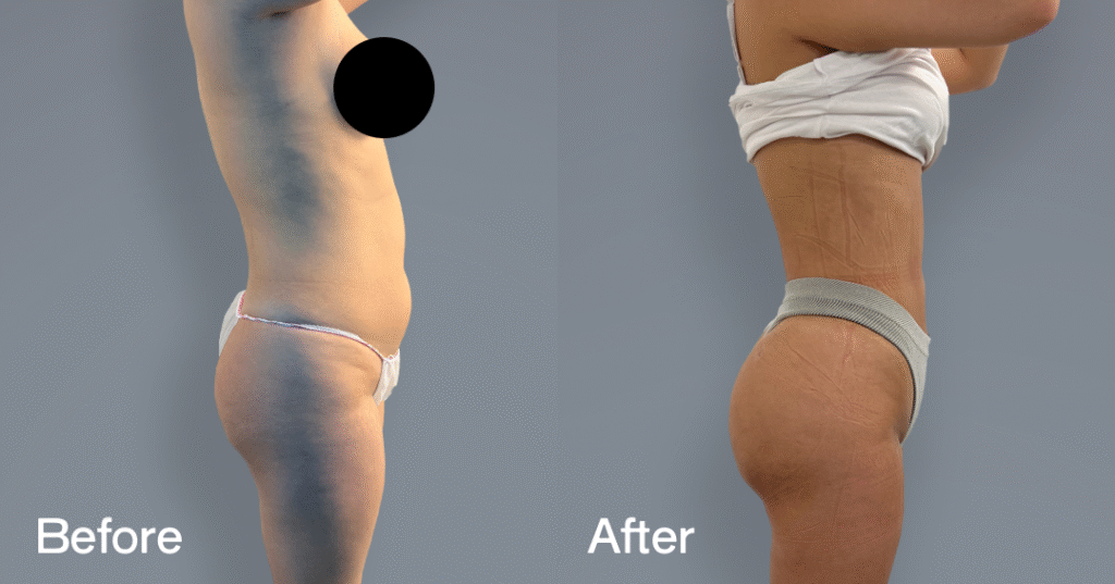 Do you want a bigger butt? Learn about the best big butt surgery from CREO Clinic in London. Before And After Bbl, Right View - Patient 8