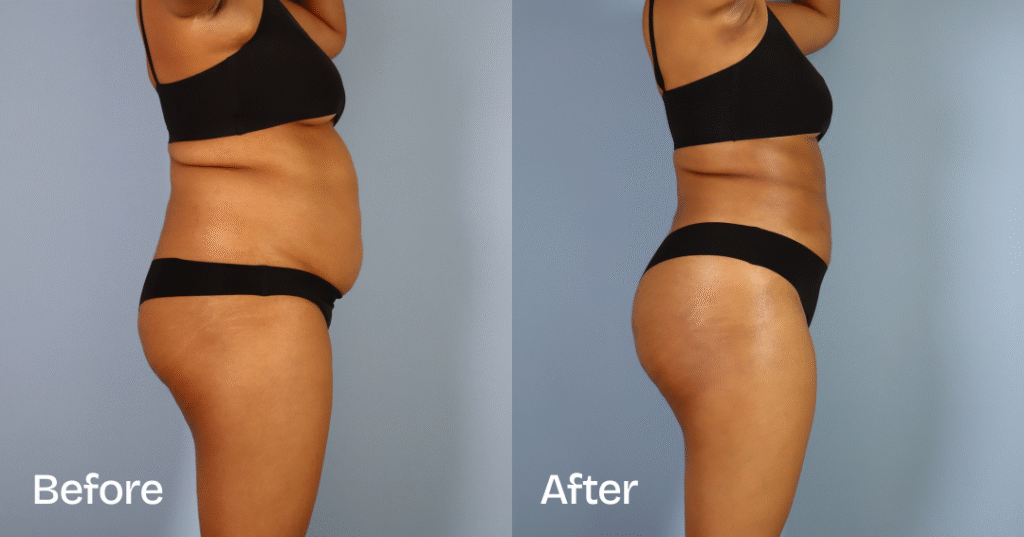 Do you want a bigger butt? Learn about the best big butt surgery from CREO Clinic in London. Big Butt Surgery