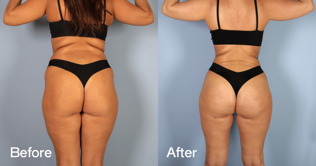 Before And After Liposuction, Back View - Patient 10