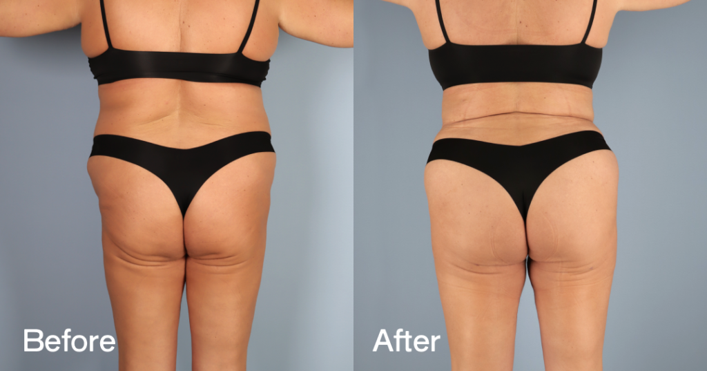 If youโre looking for a Brazilian butt lift (BBL) in London, you need a skilled surgeon to keep you safe while sculpting the curves youโve always wanted. Before And After Bbl, Back View - Patient 9
