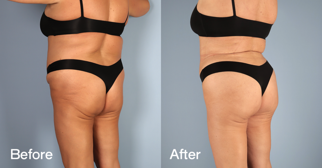 If youโre looking for a Brazilian butt lift (BBL) in London, you need a skilled surgeon to keep you safe while sculpting the curves youโve always wanted. Before And After Bbl, Back Left View - Patient 9
