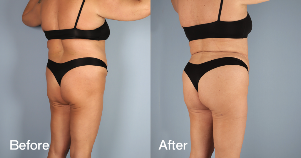 If youโre looking for a Brazilian butt lift (BBL) in London, you need a skilled surgeon to keep you safe while sculpting the curves youโve always wanted. Before And After Bbl, Back Right View - Patient 9