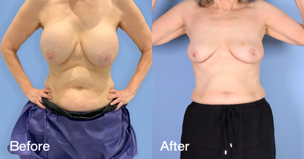 When youโre unhappy with your breast augmentation, you need an experienced surgeon to safely remove your implants while preserving the natural contours of your breasts.With breast implant removal surgery (explant surgery) in London,, Dr. Omar Tillo safely removes silicone or saline implants from the chest, reducing the volume of your breasts. Before And After Breast Implant Removal Surgery, Front View - Patient 1