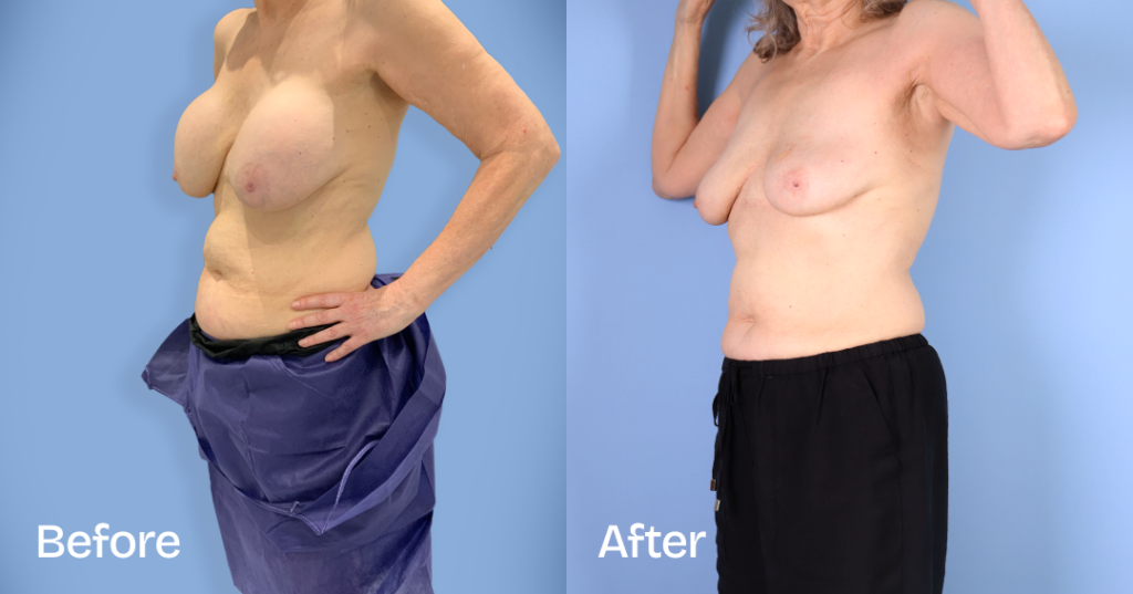 When youโre unhappy with your breast augmentation, you need an experienced surgeon to safely remove your implants while preserving the natural contours of your breasts.With breast implant removal surgery (explant surgery) in London,, Dr. Omar Tillo safely removes silicone or saline implants from the chest, reducing the volume of your breasts. Before And After Breast Implant Removal Surgery, Front Left View - Patient 1