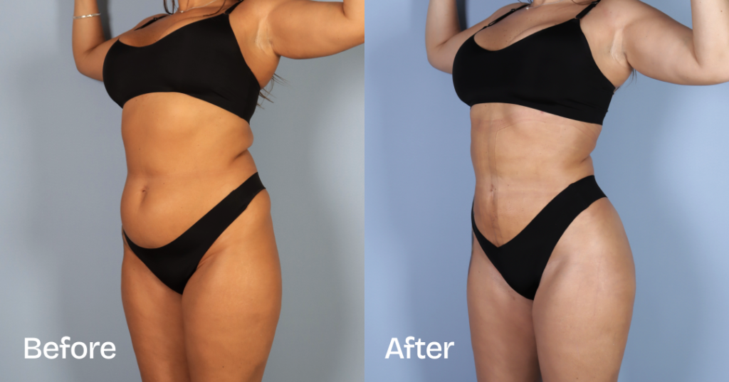 Before And After Liposuction, Front Left View - Patient 10