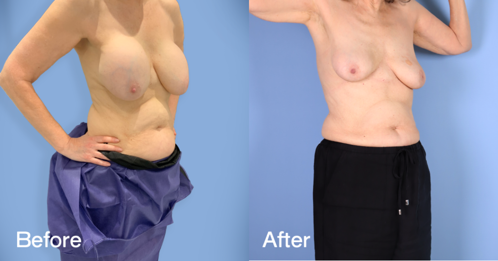 When youโre unhappy with your breast augmentation, you need an experienced surgeon to safely remove your implants while preserving the natural contours of your breasts.With breast implant removal surgery (explant surgery) in London,, Dr. Omar Tillo safely removes silicone or saline implants from the chest, reducing the volume of your breasts. Before And After Breast Implant Removal Surgery, Front Right View - Patient 1