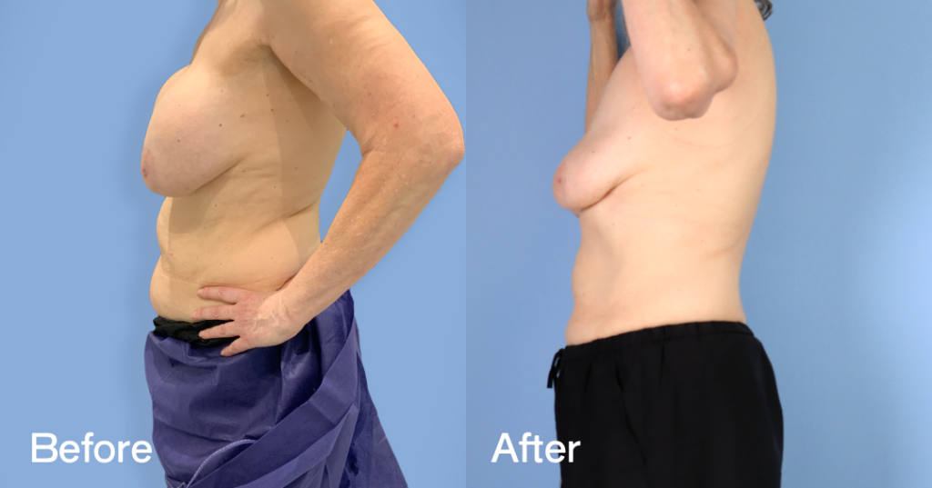 When youโre unhappy with your breast augmentation, you need an experienced surgeon to safely remove your implants while preserving the natural contours of your breasts.With breast implant removal surgery (explant surgery) in London,, Dr. Omar Tillo safely removes silicone or saline implants from the chest, reducing the volume of your breasts. Before And After Breast Implant Removal Surgery, Left View - Patient 1