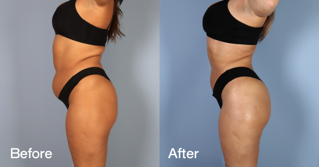 Before And After Liposuction, Left View - Patient 10