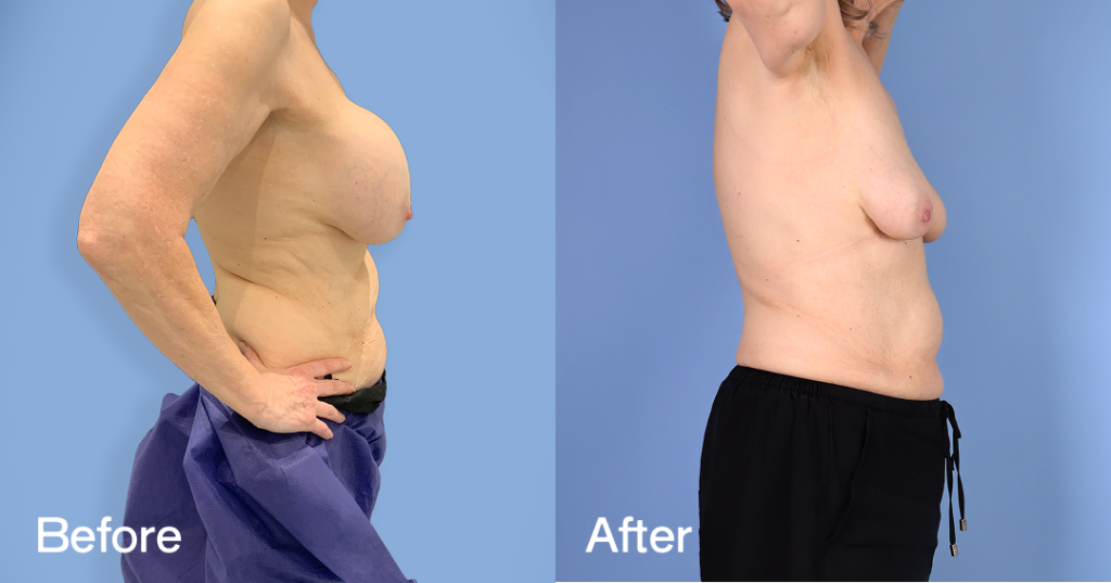 When youโre unhappy with your breast augmentation, you need an experienced surgeon to safely remove your implants while preserving the natural contours of your breasts.With breast implant removal surgery (explant surgery) in London,, Dr. Omar Tillo safely removes silicone or saline implants from the chest, reducing the volume of your breasts. Before And After Breast Implant Removal Surgery, Right View - Patient 1