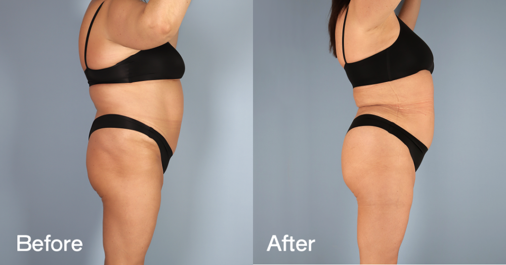 If youโre looking for a Brazilian butt lift (BBL) in London, you need a skilled surgeon to keep you safe while sculpting the curves youโve always wanted. Before And After Bbl, Right View - Patient 9