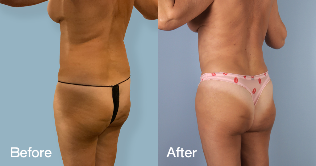 Before And After Fat Transfer To Hips, Back Left View - Patient 310