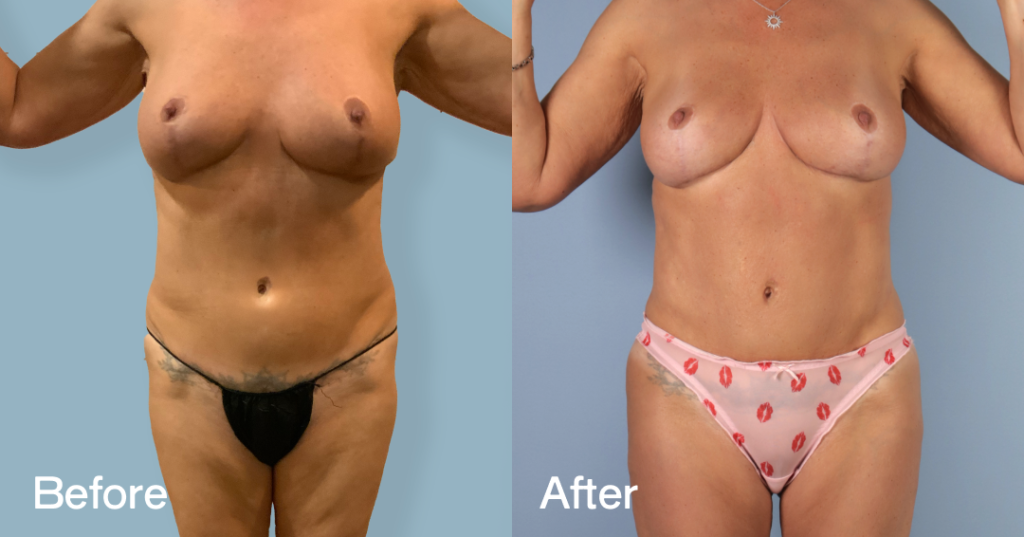 Before And After Fat Transfer To Hips, Front View - Patient 310