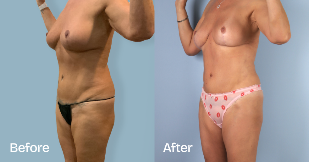 Before And After Fat Transfer To Hips, Front Left View - Patient 310