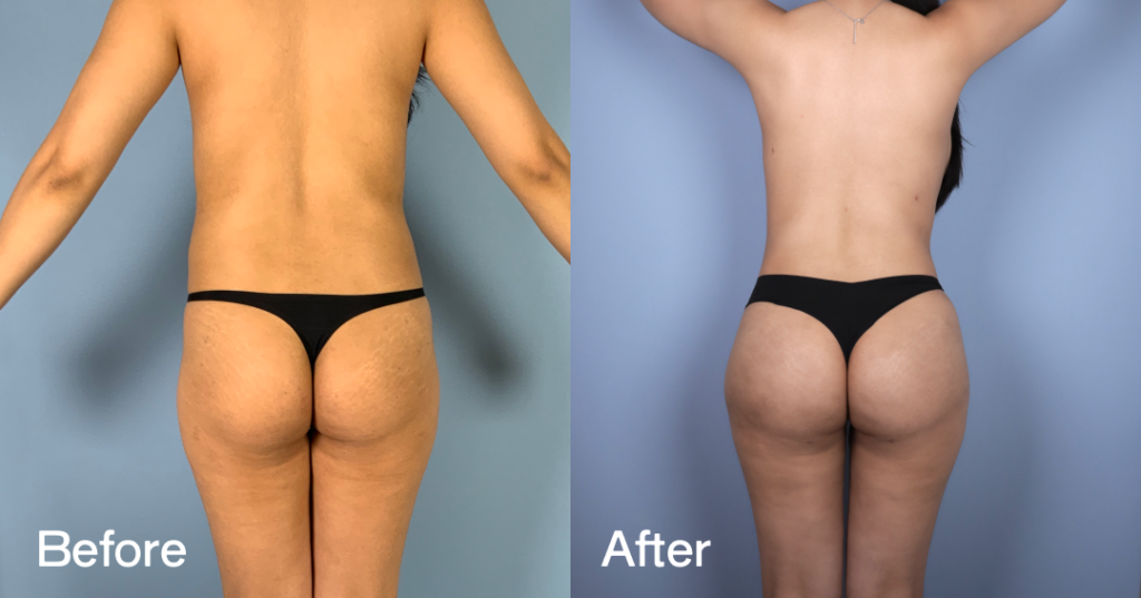 If youโre looking for a Brazilian butt lift (BBL) in London, you need a skilled surgeon to keep you safe while sculpting the curves youโve always wanted. Before And After Bbl, Back View - Patient 10