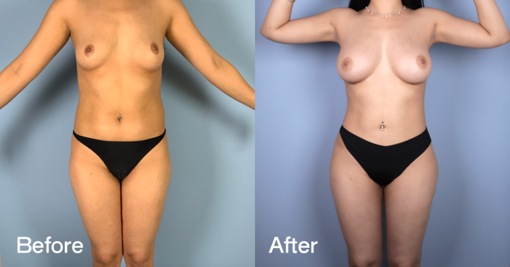 Before And After Fat Transfer Breast Augmentation Surgery, Front View - Patient 6