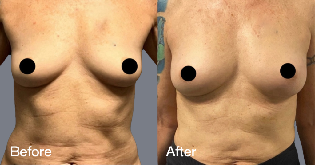 Fat transfer breast augmentation describes the procedure where fat is moved from different areas of the body to the breasts to increase the volume and enhance the shape. Before And After Fat Transfer Breast Augmentation Surgery, Front Left View - Patient 7